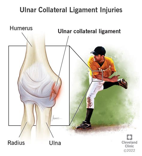 test for ucl tear|how to prevent ucl injuries.